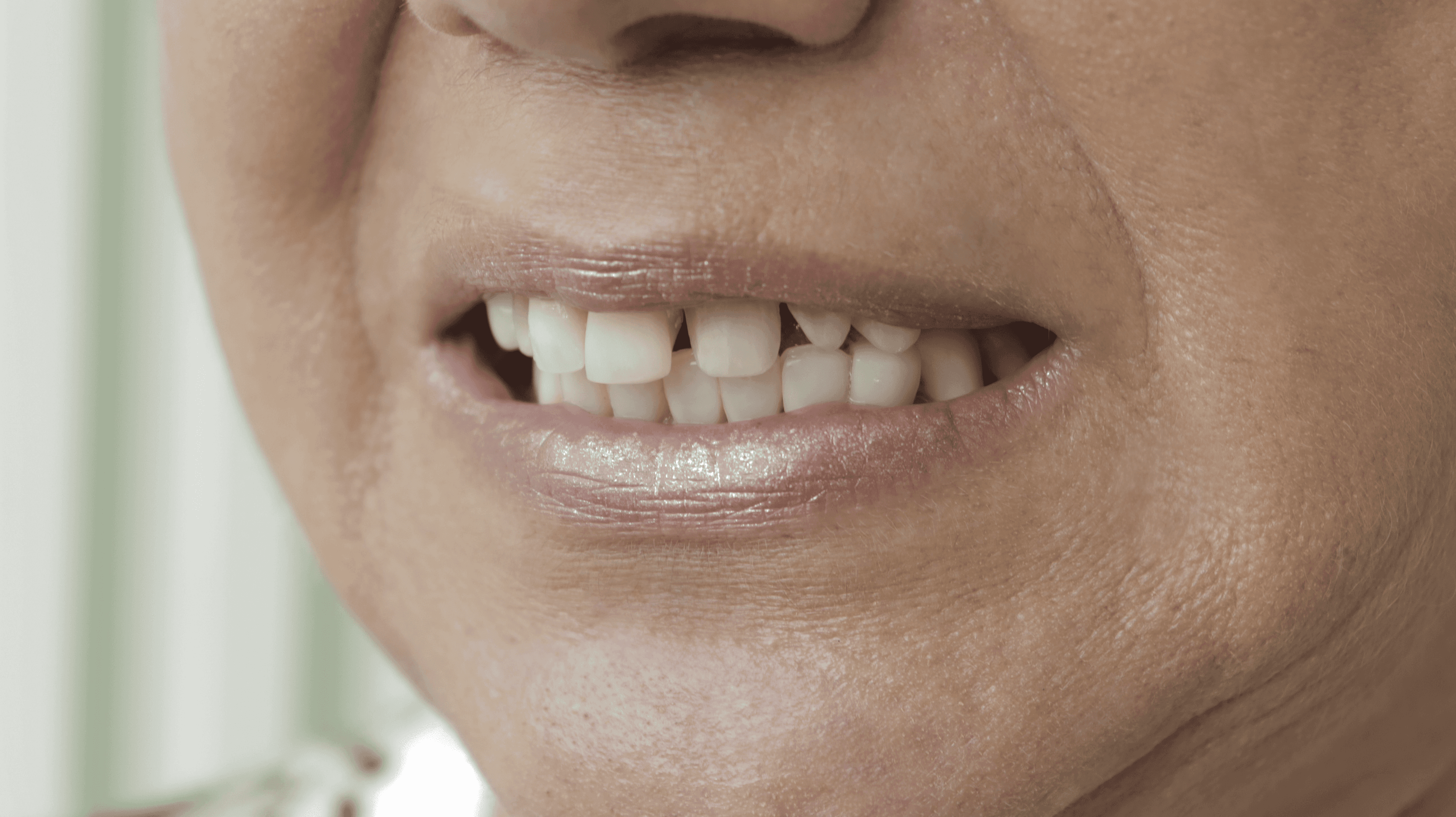 Before Lentes Cerámicos Naturales