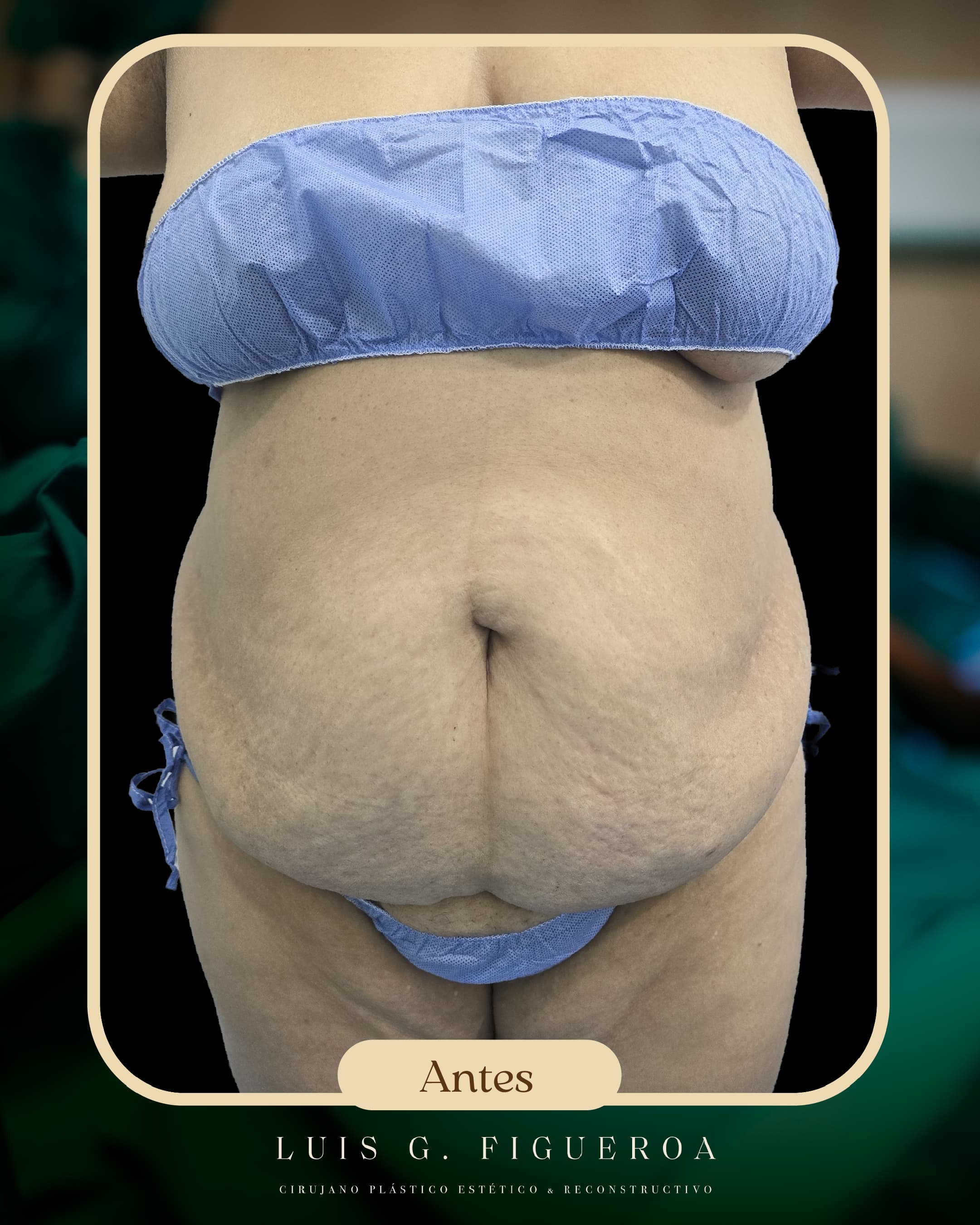 Before Lipoabdominoplastia