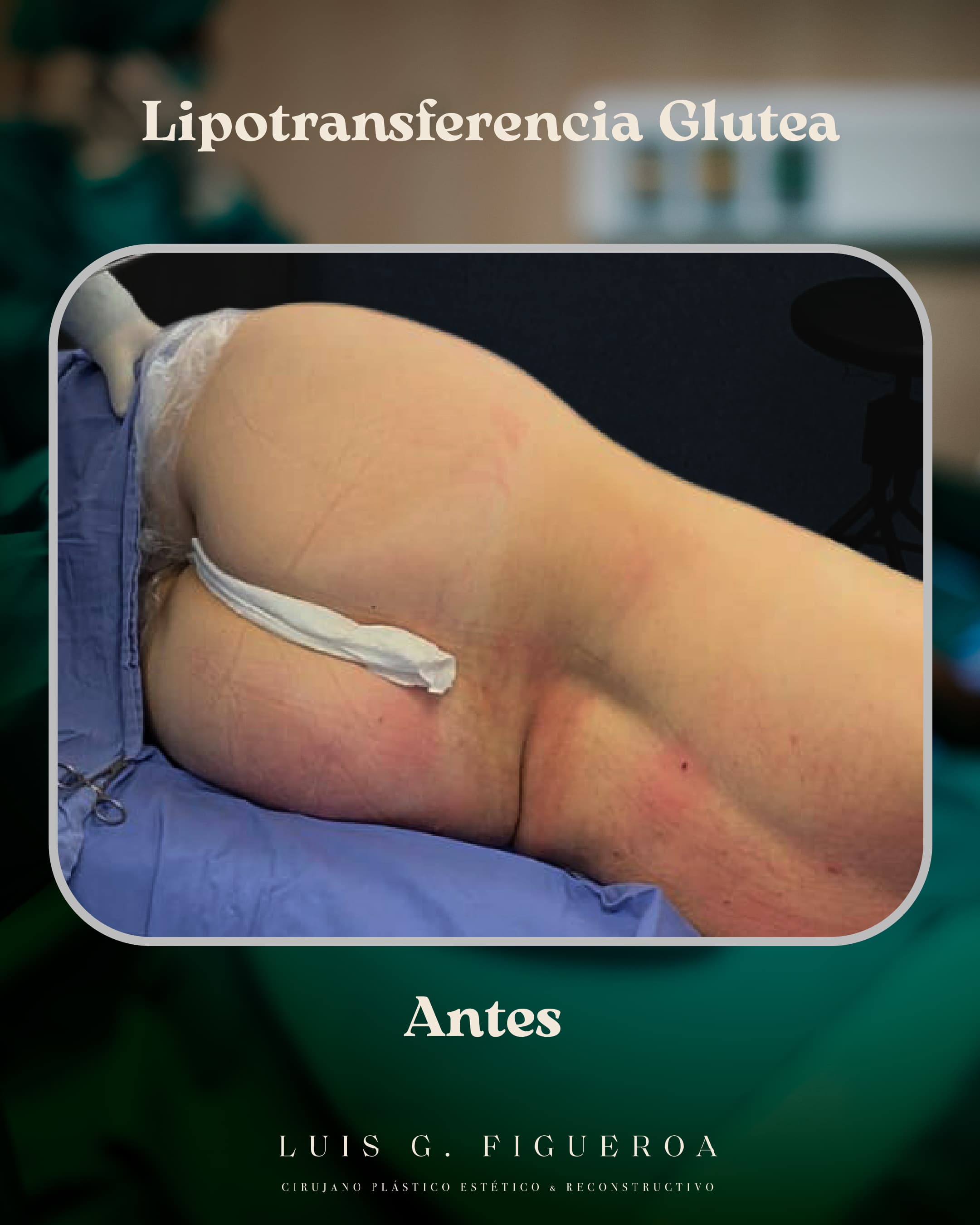 Before Lipotransferencia