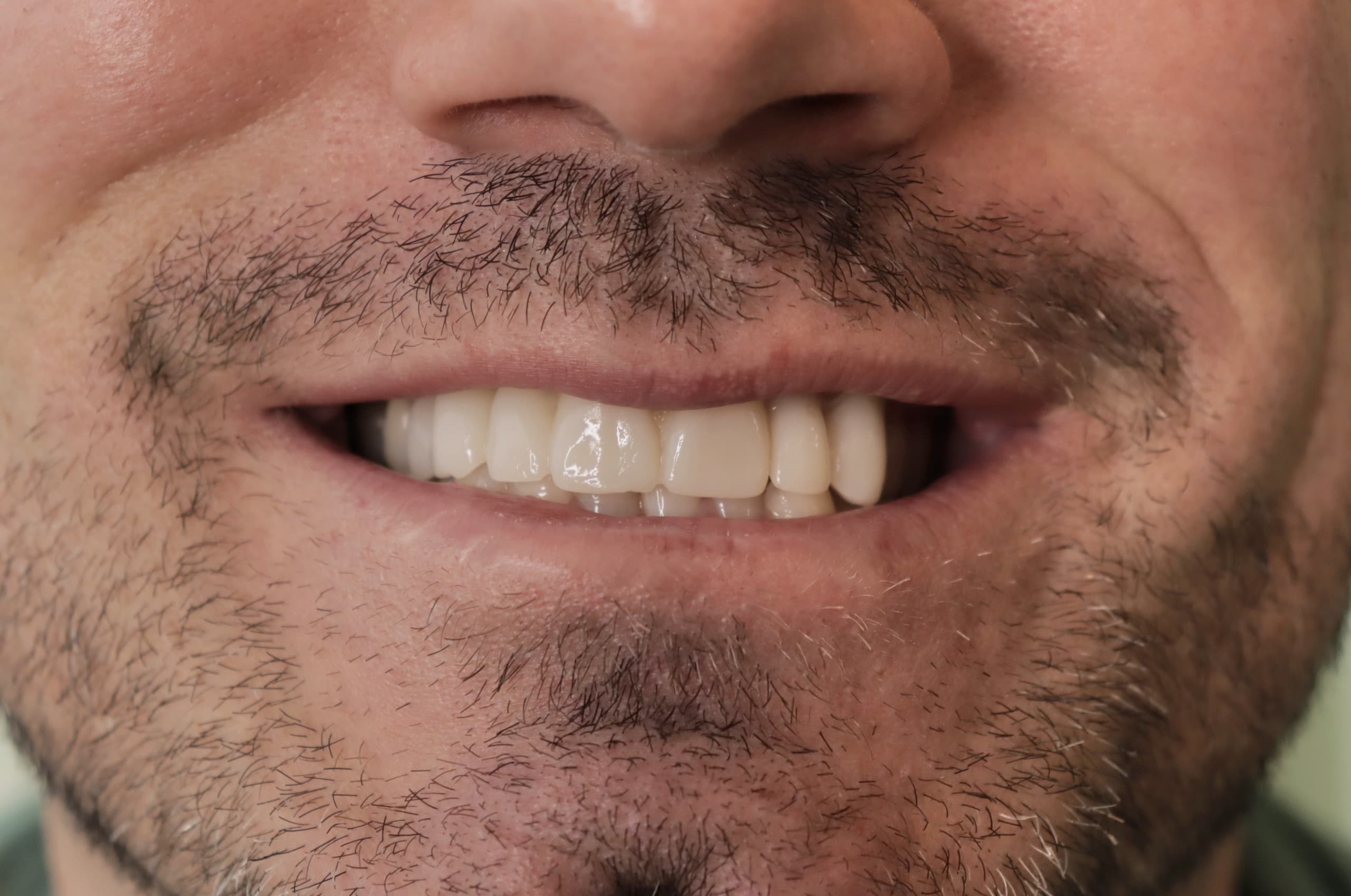 Before Lentes Cerámicos Naturales 