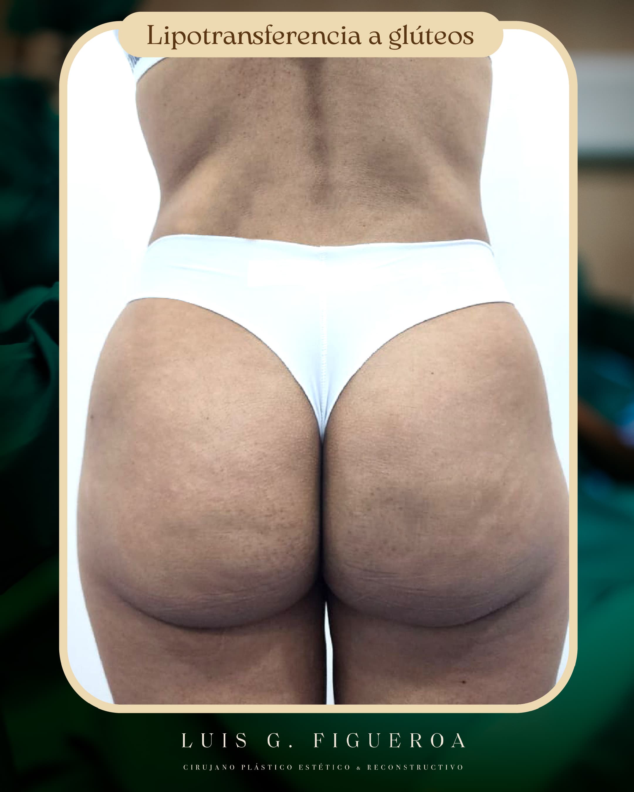 After Lipotransferencia