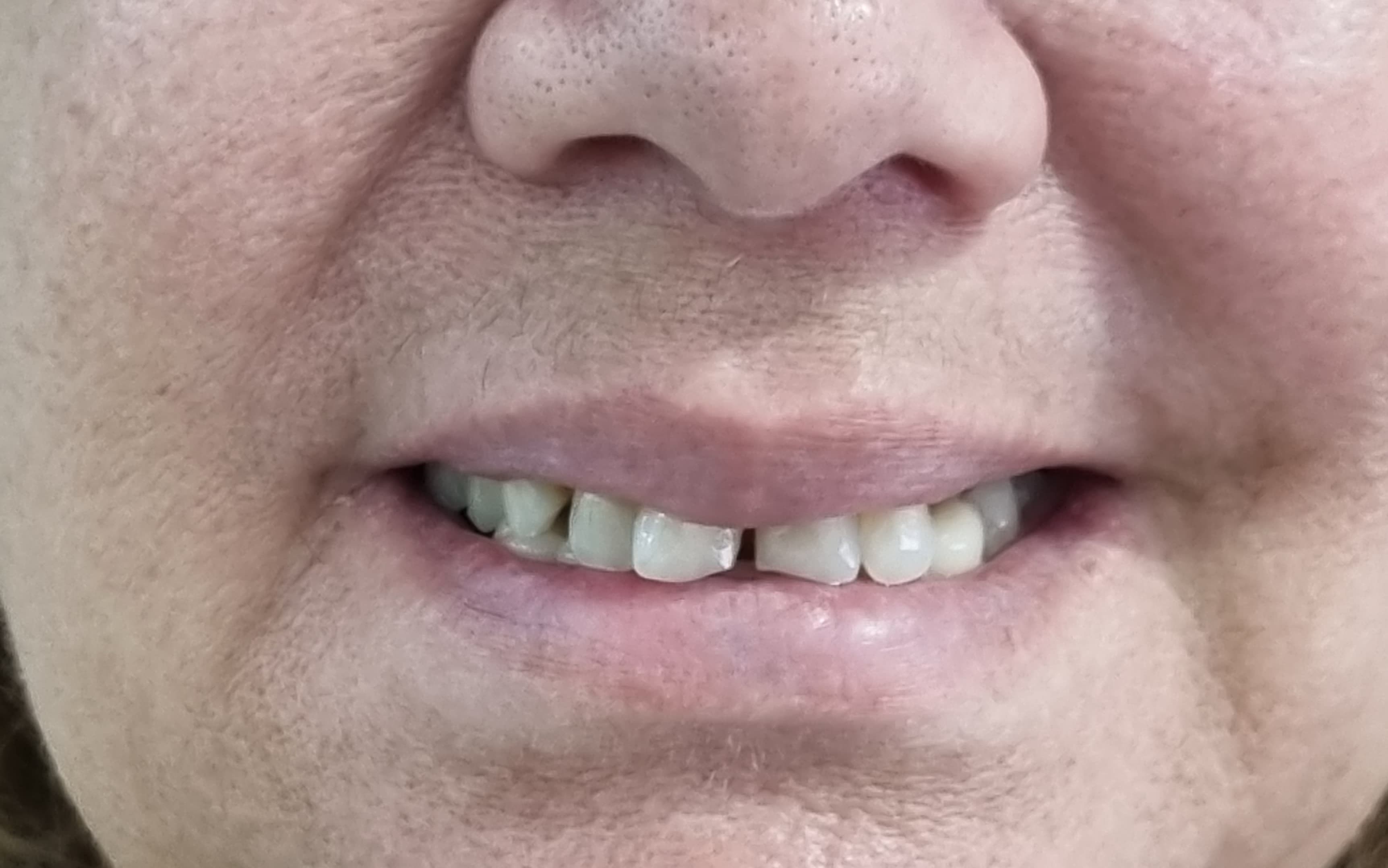 Before Porcelain veneers