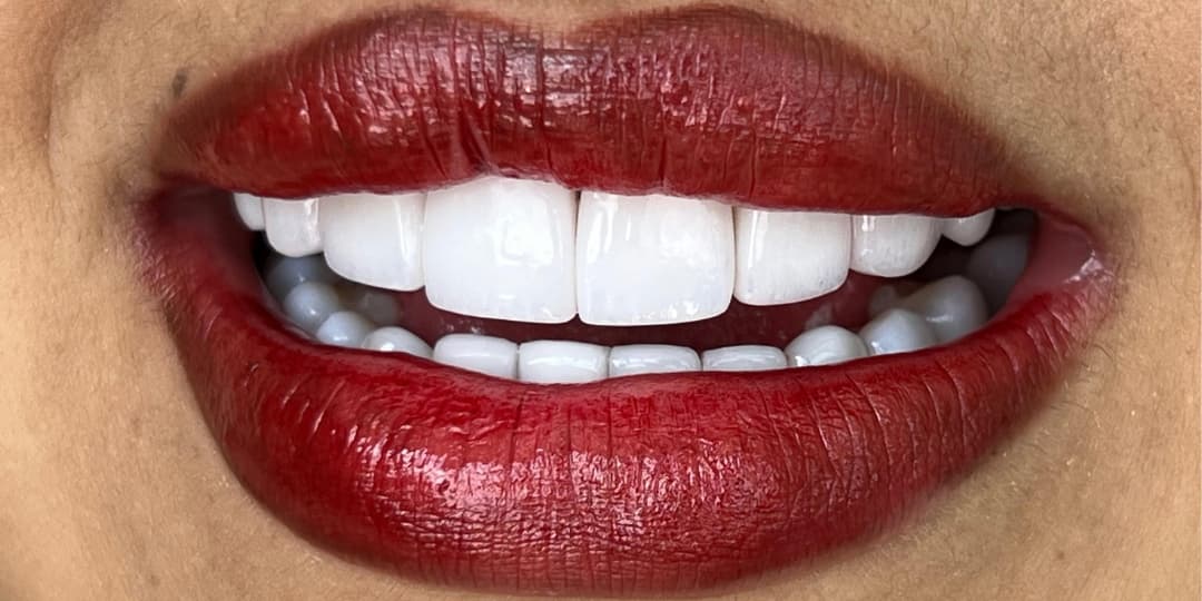 After Carillas cerámicas y perfilamiento de labios