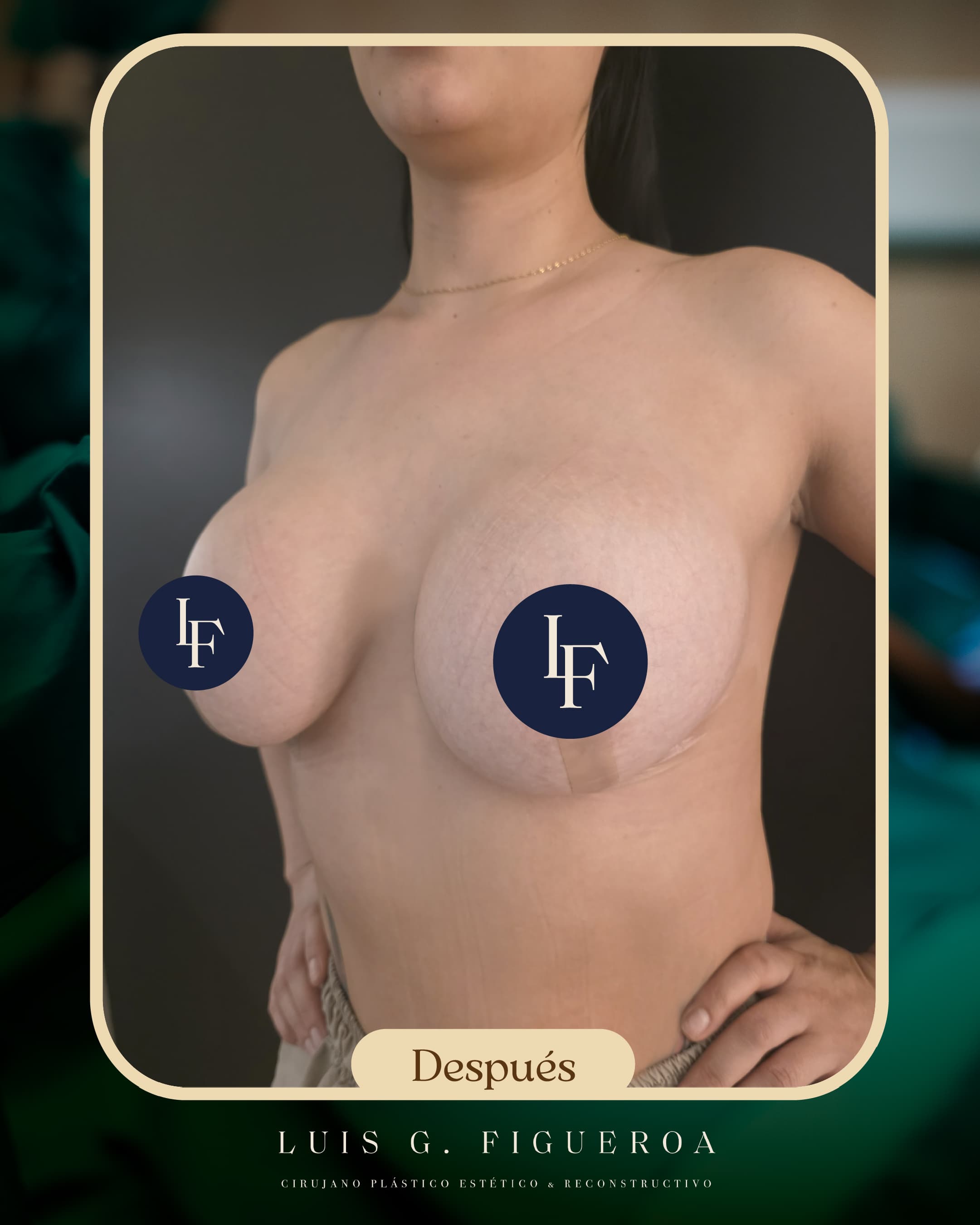 After Maxtopexia con implantes