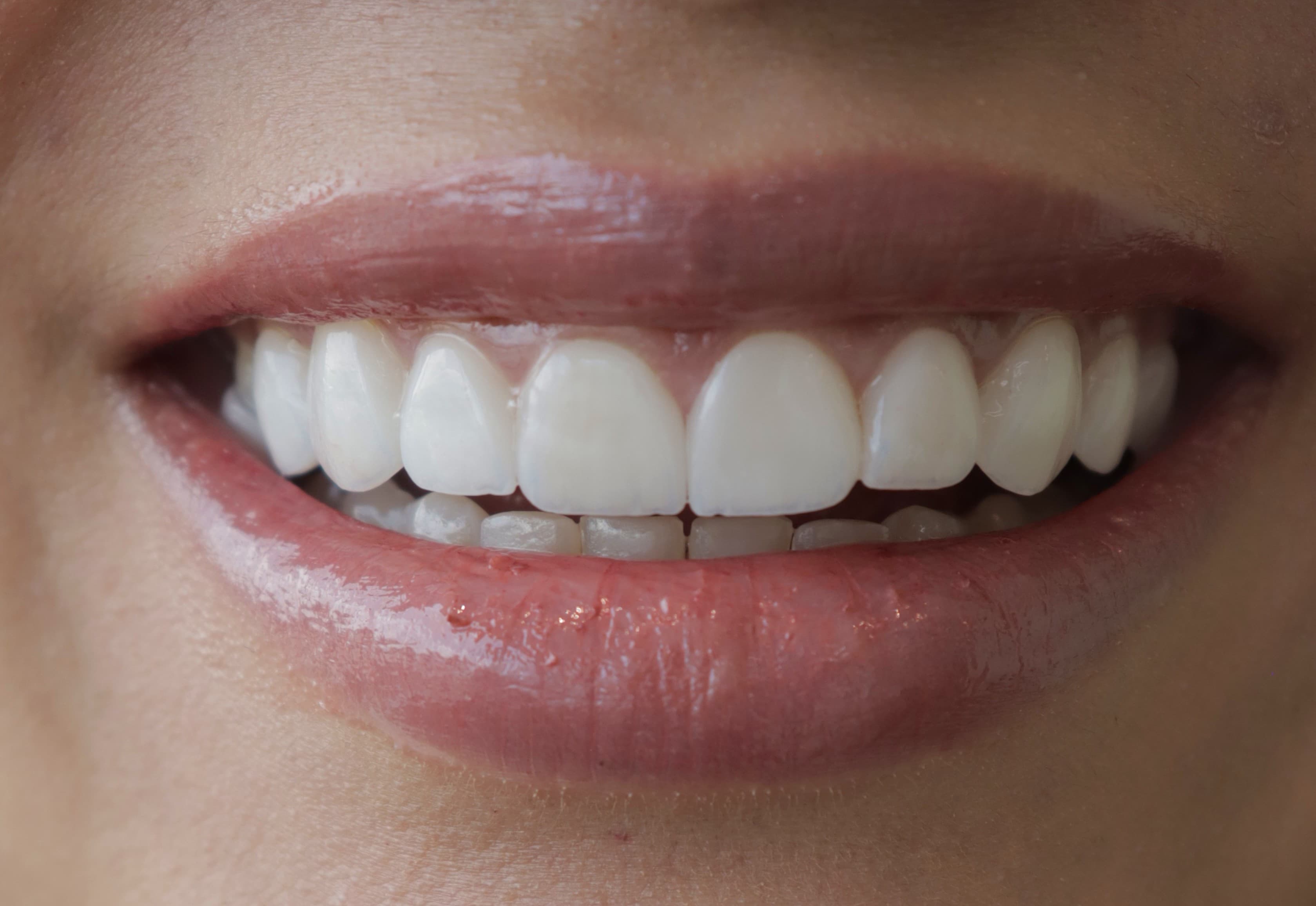 After Lentes Cerámicos Naturales