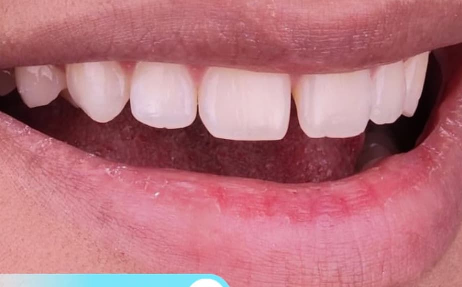 Before Smile design