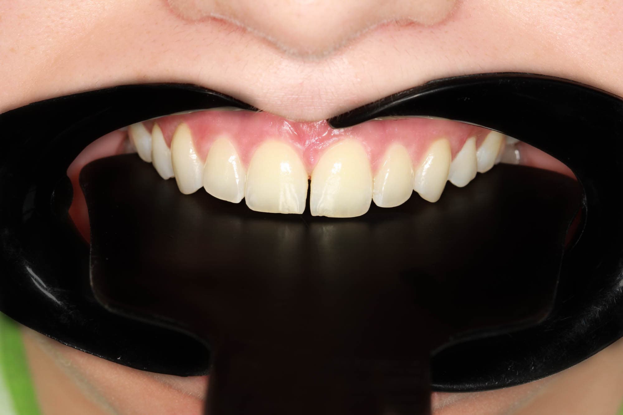 Before Lentes Cerámicos Naturales