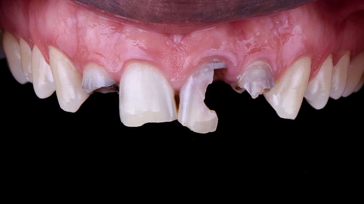 Before Carilla en resina compuesta 