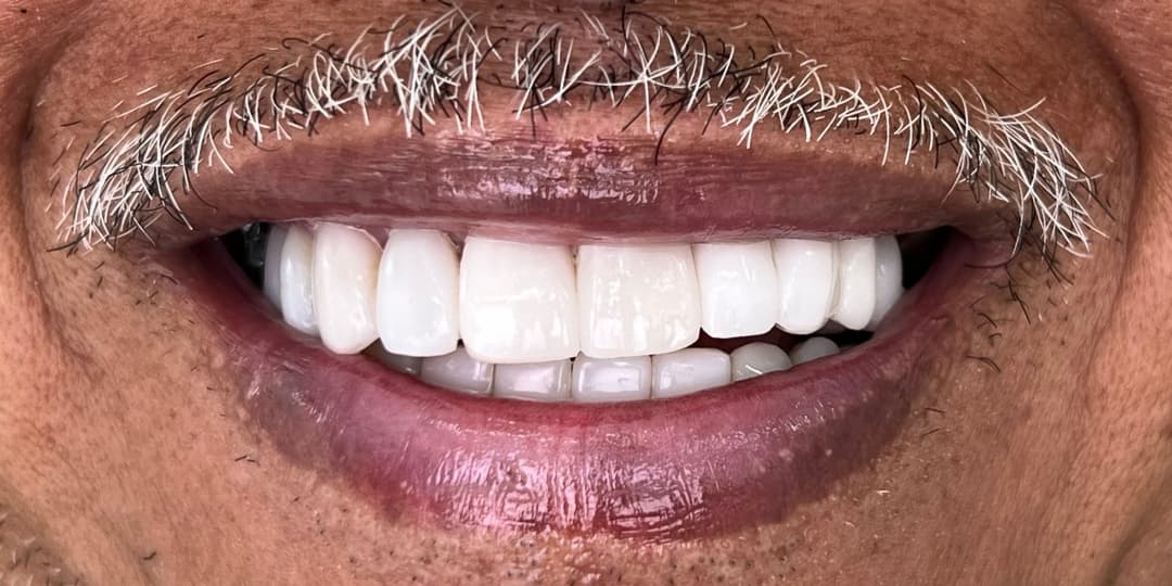 After Rehabilitación + carillas cerámicas