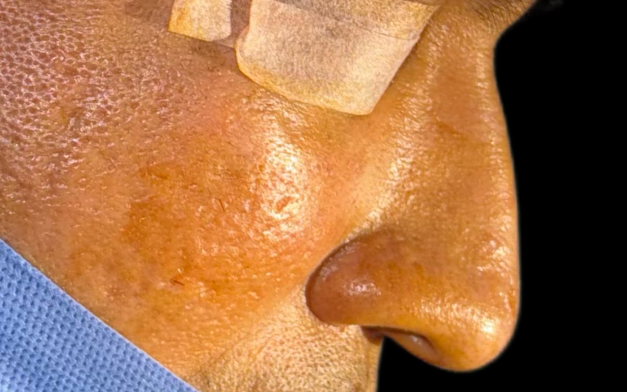 Before Ultrasonic rhinoplasty