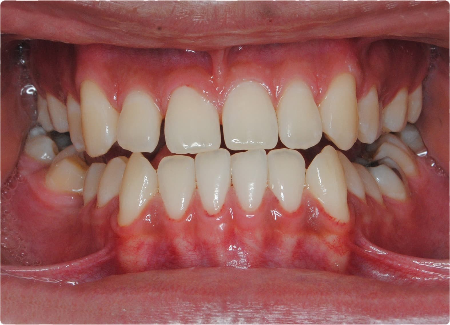 Before Ortodoncia Autoligado 