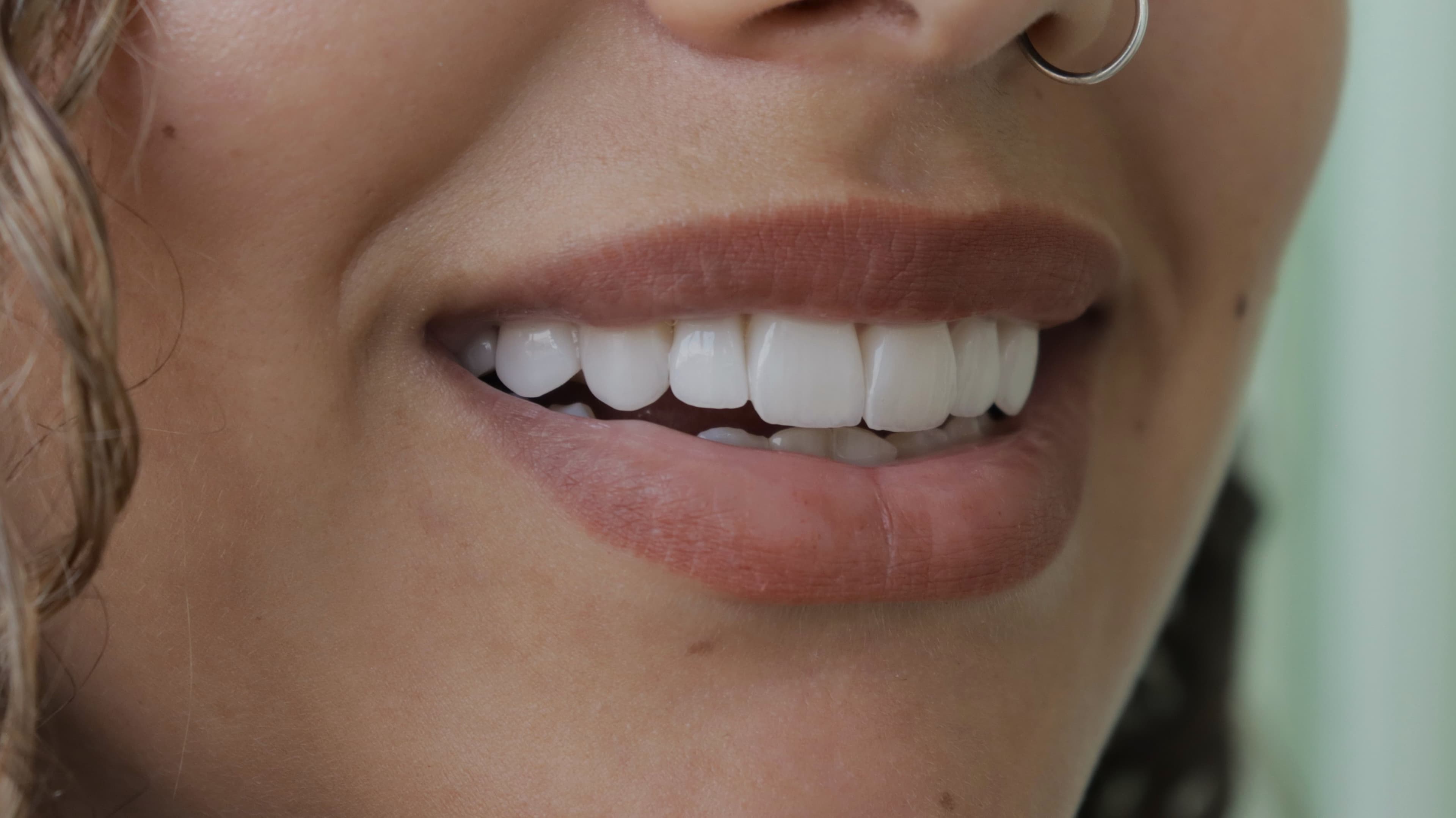 After Lentes Cerámicos Naturales