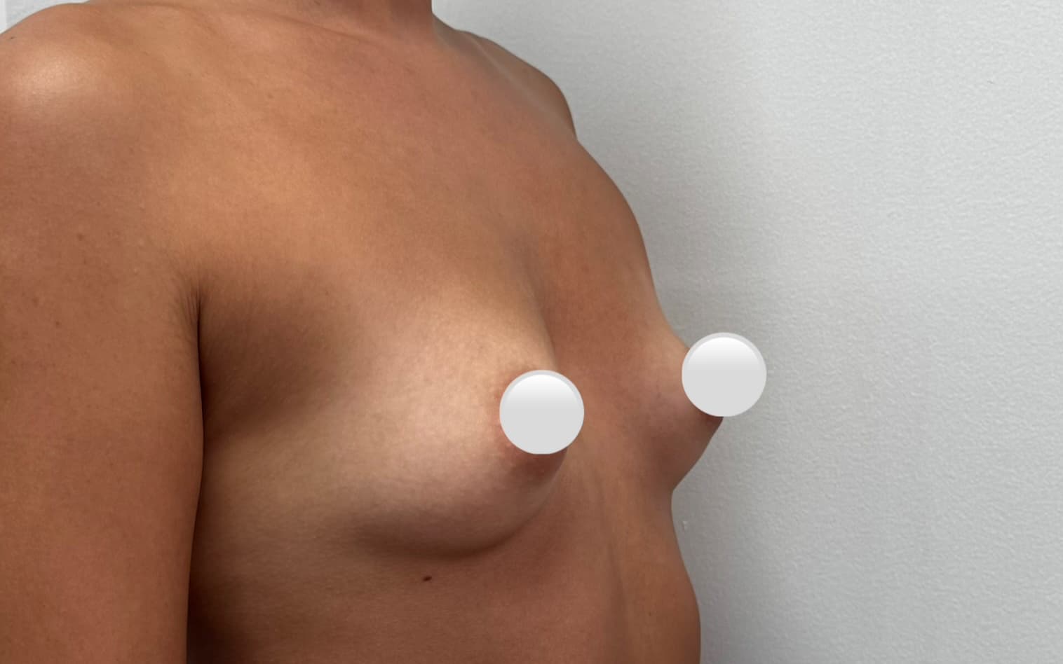 Before Augmentation mammaplasty