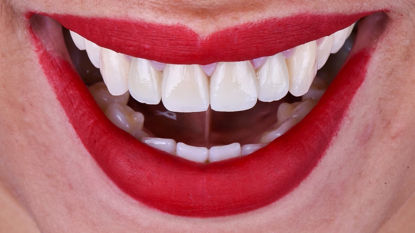 After Coronas en zirconio con ceramica estratificado 