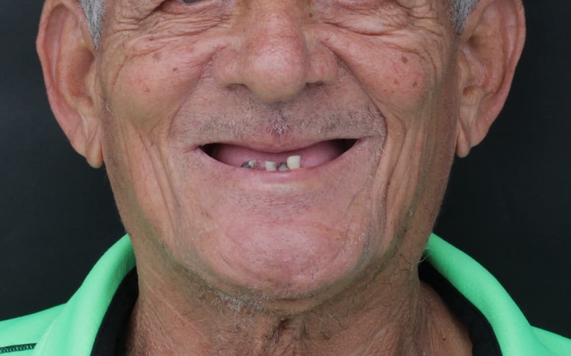 Before Dental implants