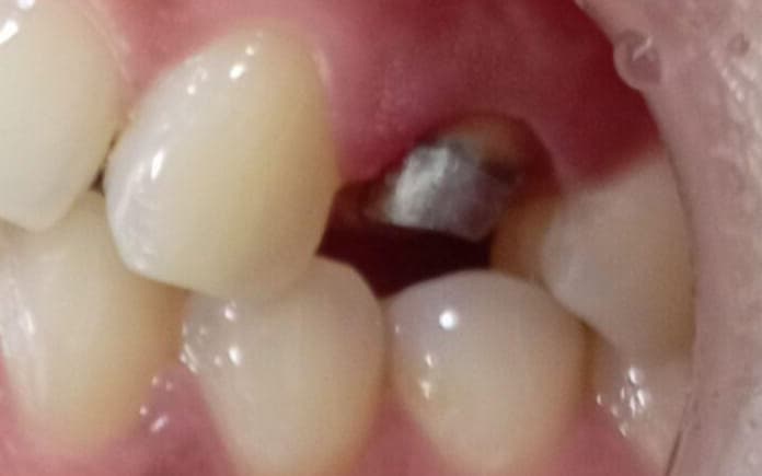 Before Corona en Zirconia