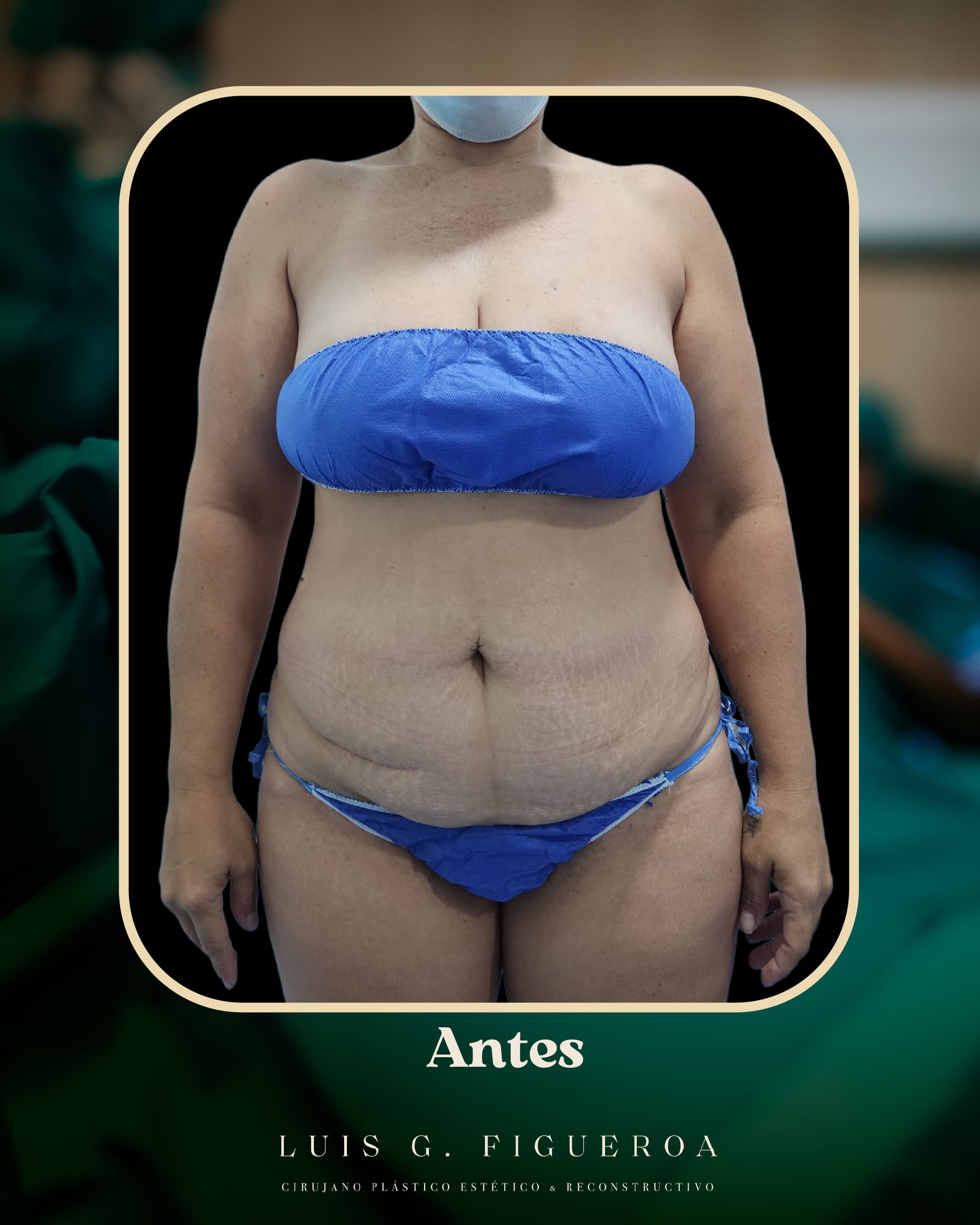 Before Mommy makeover