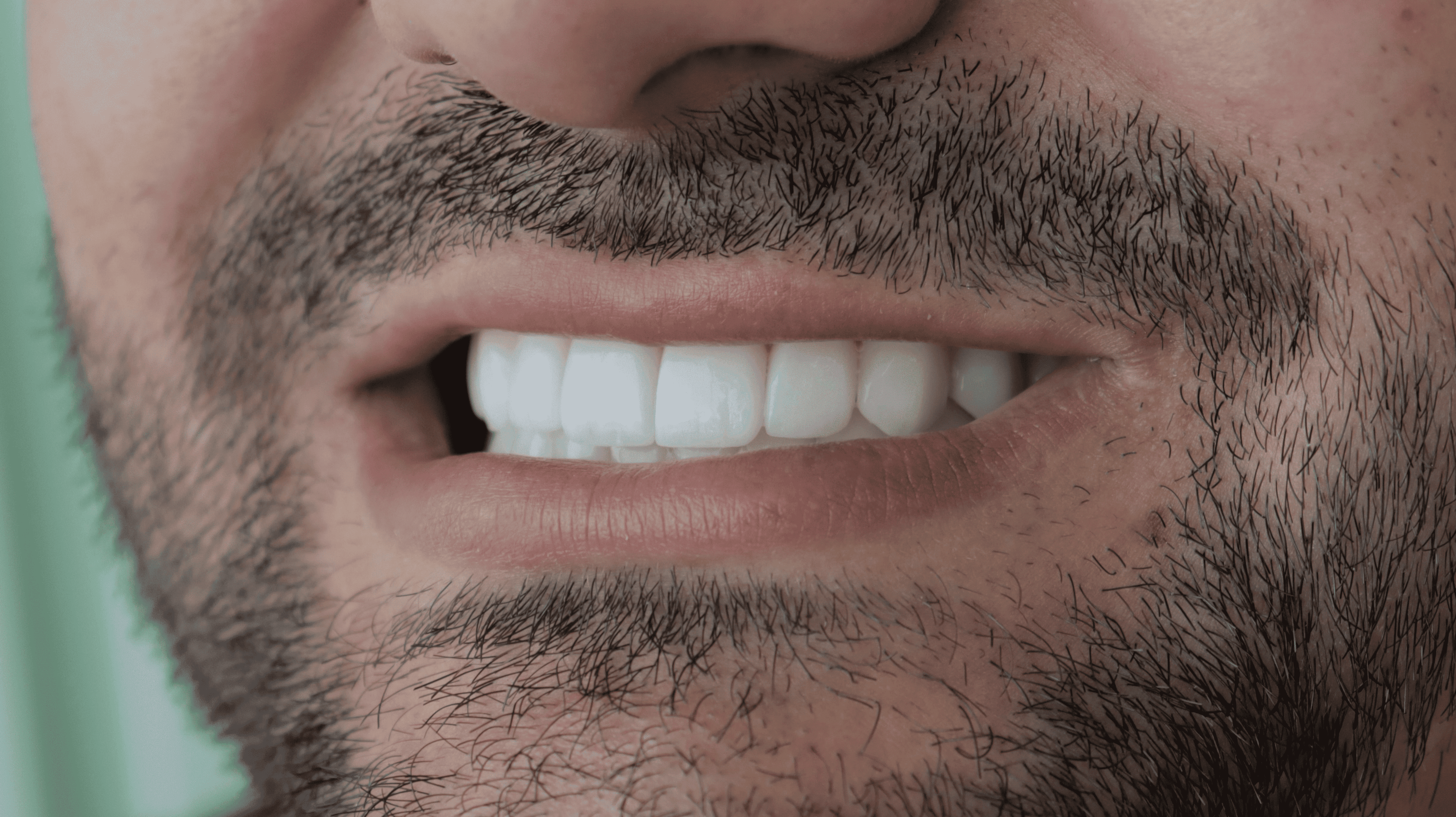 After Lentes cerámicos naturales 