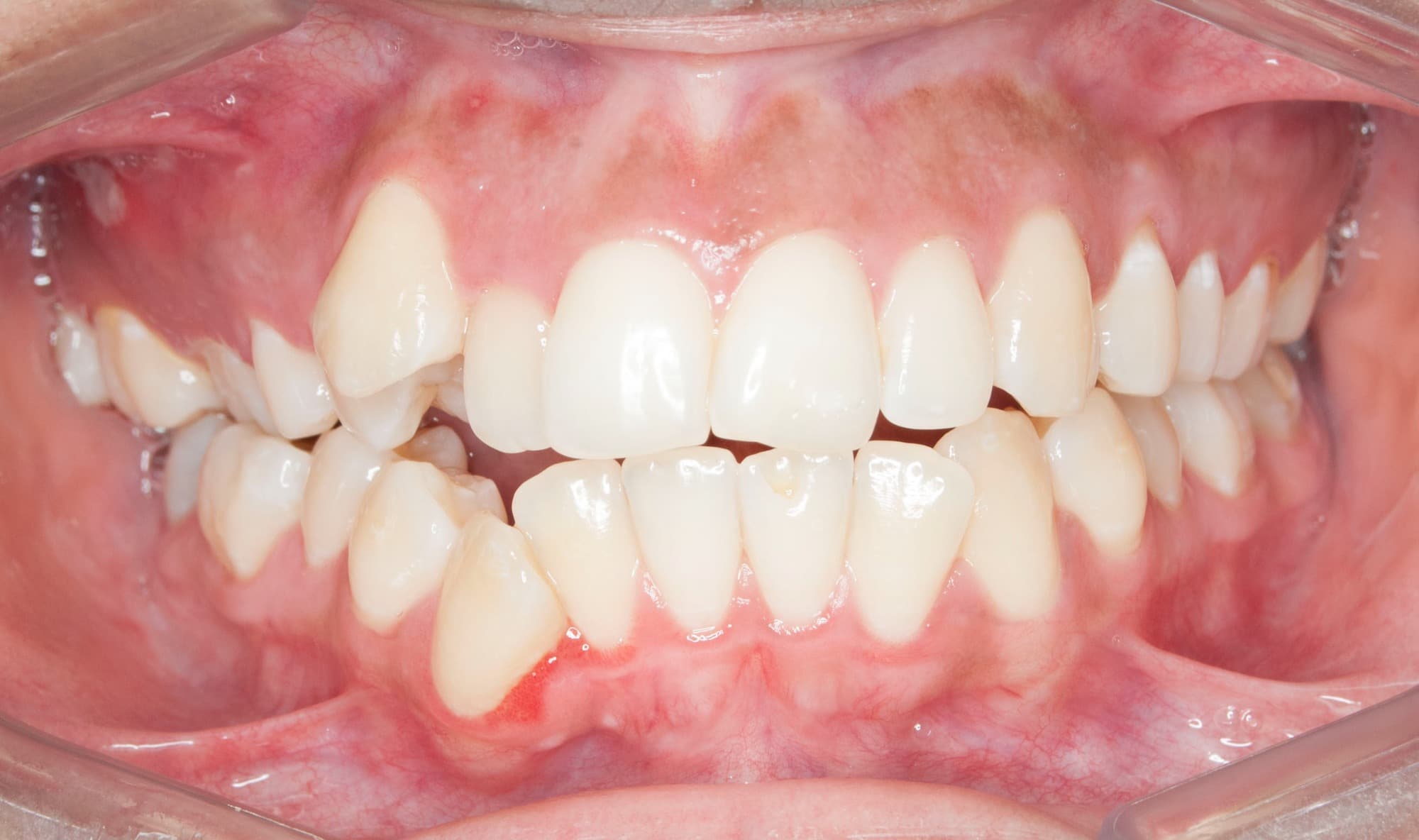 Before Ortodoncia Autoligado 