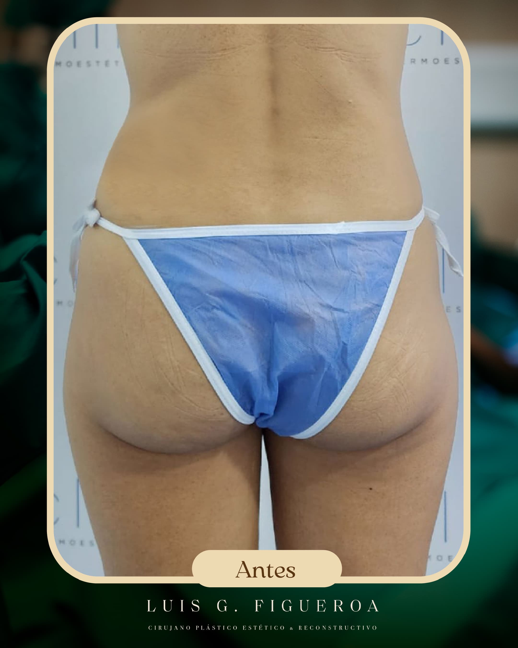 Before Lipotransferencia