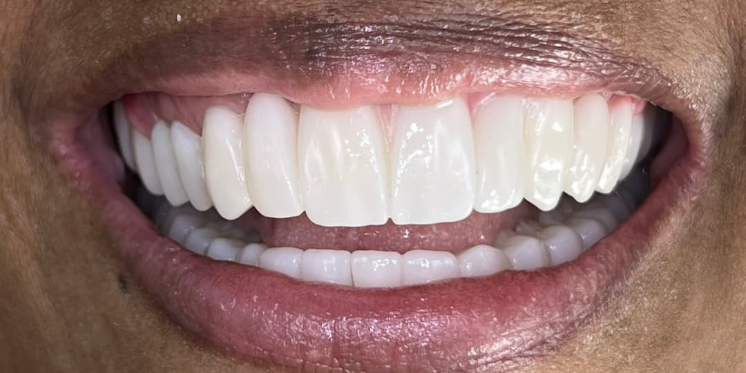 After Rehabilitación completa