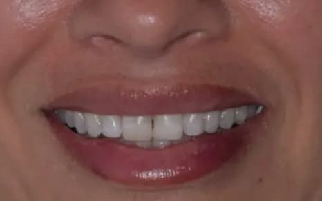 Before LENTES CERAMICOS