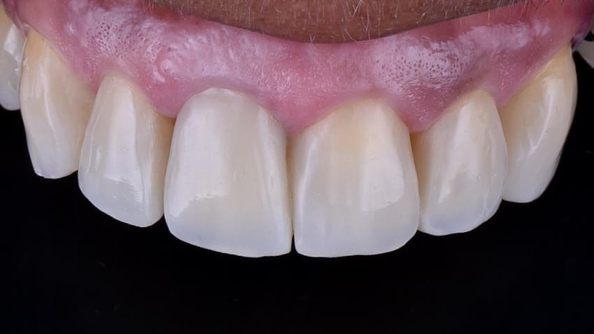 After Carillas en resina compuesta