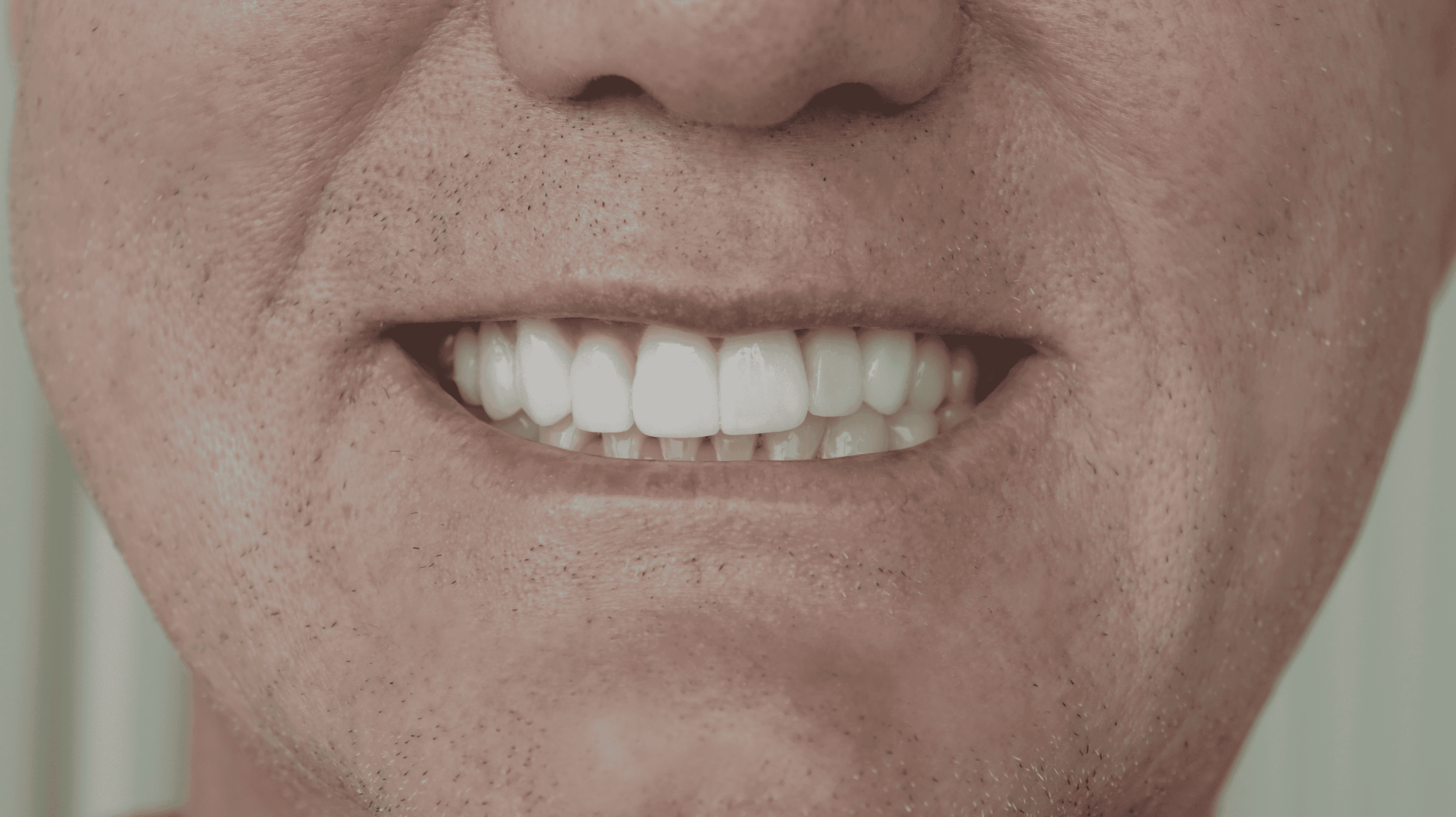 After Lentes Ceramicos Naturales 