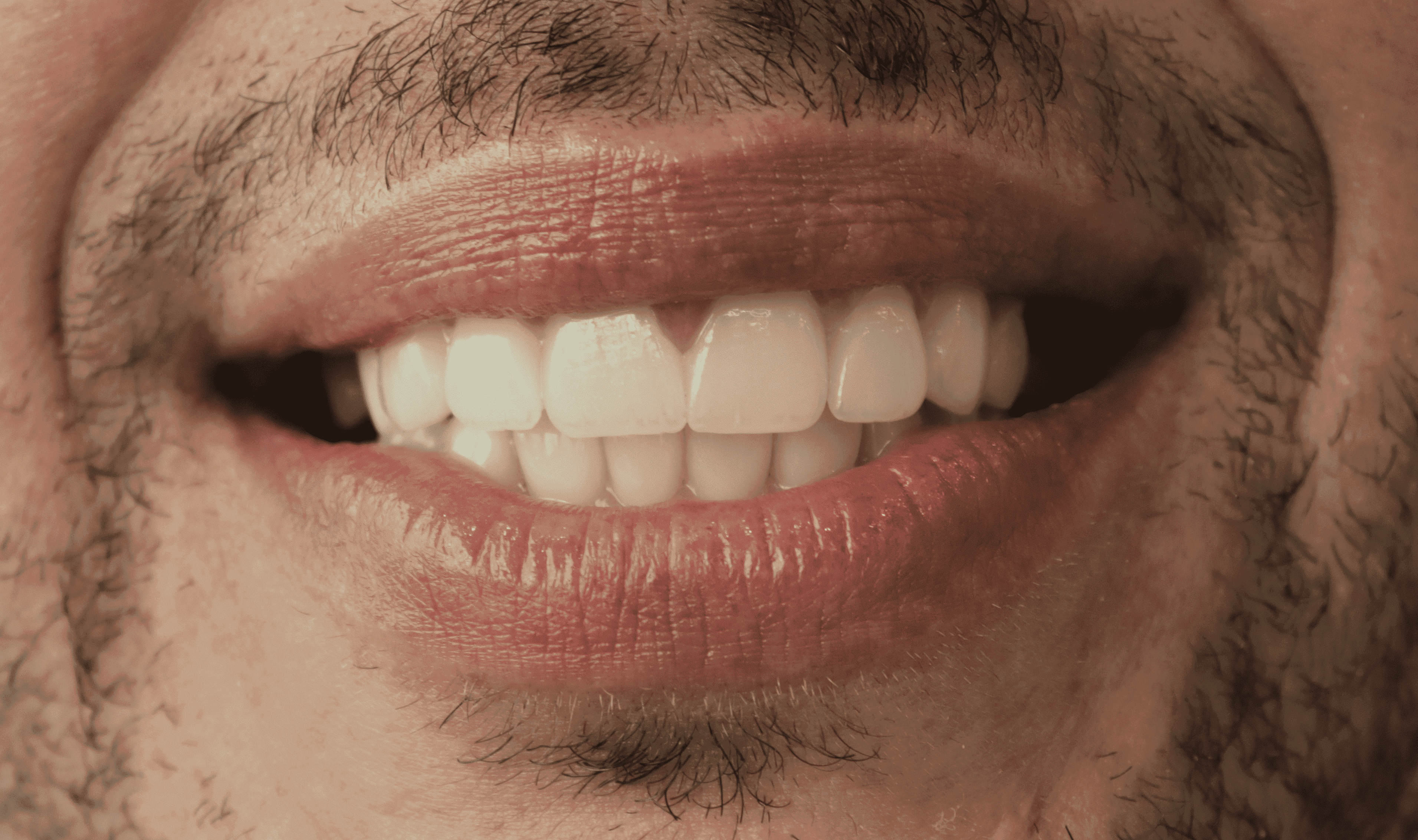 After Lentes Cerámicos Naturales