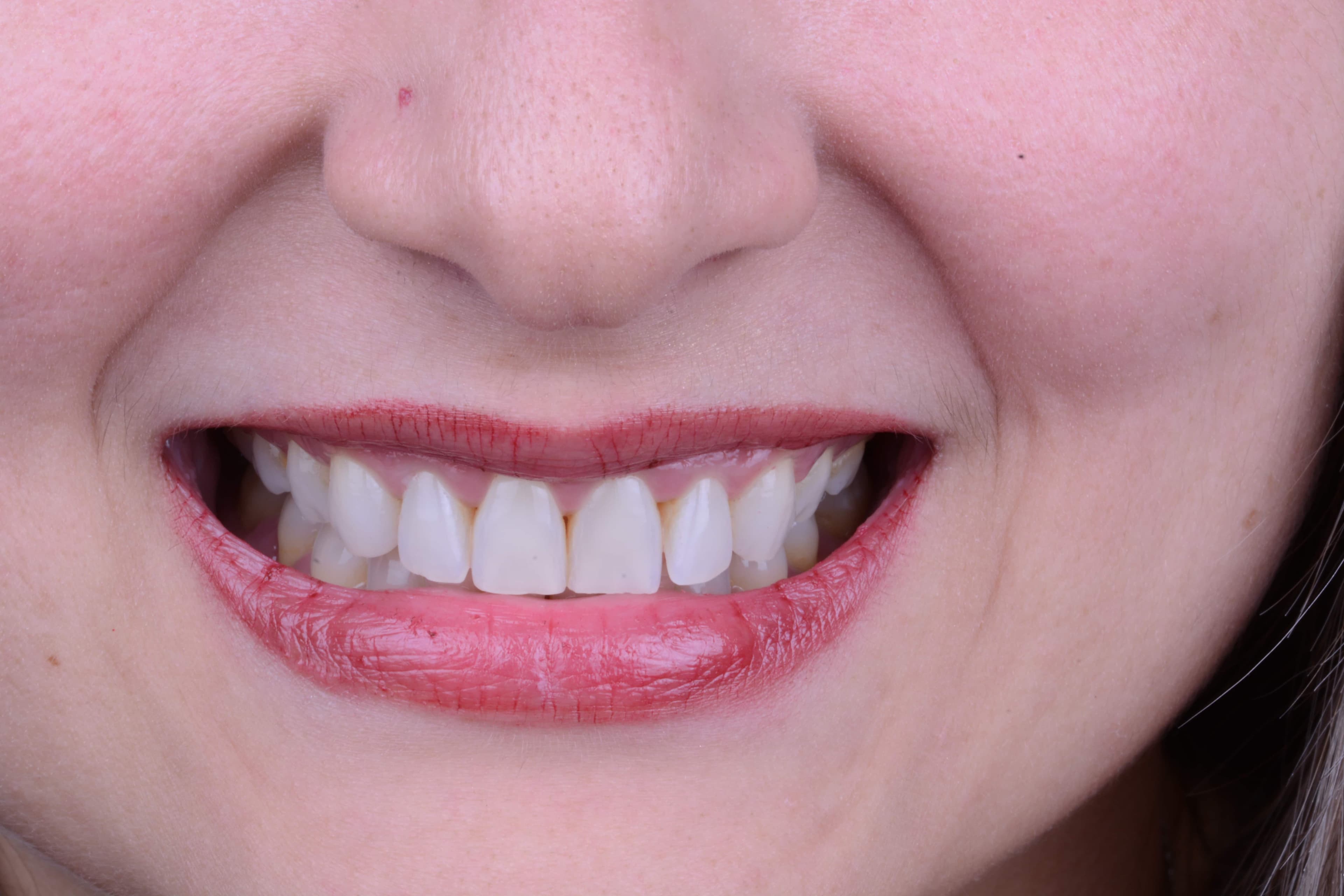 After Blanqueamiento dental 