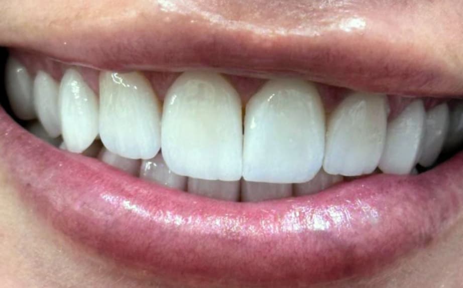 After Porcelain veneers.