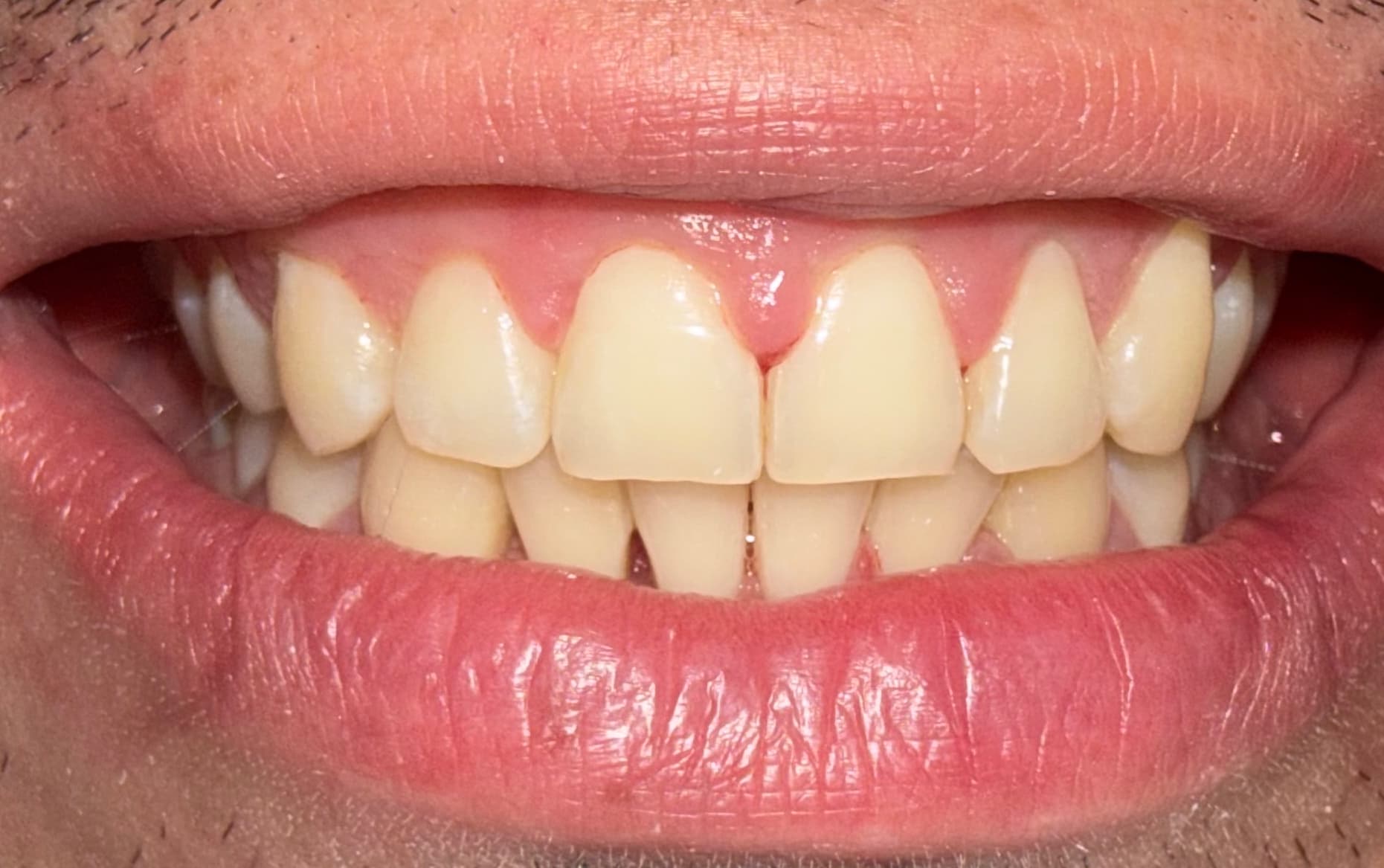 Before Dental veneers