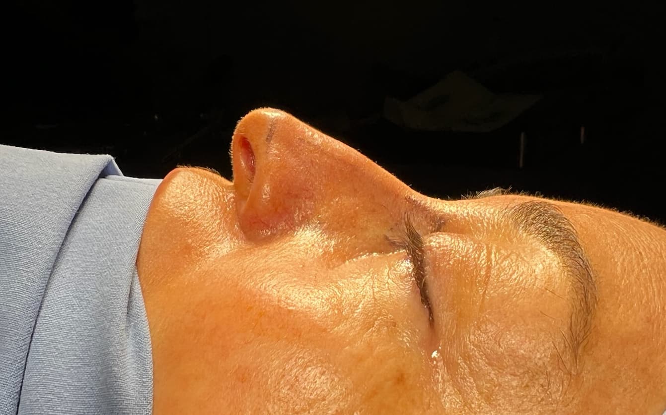 Before Ultrasonic rhinoplasty
