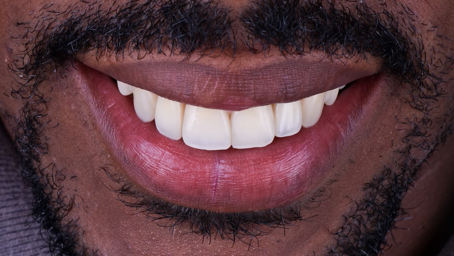 After Carilla en resina compuesta 