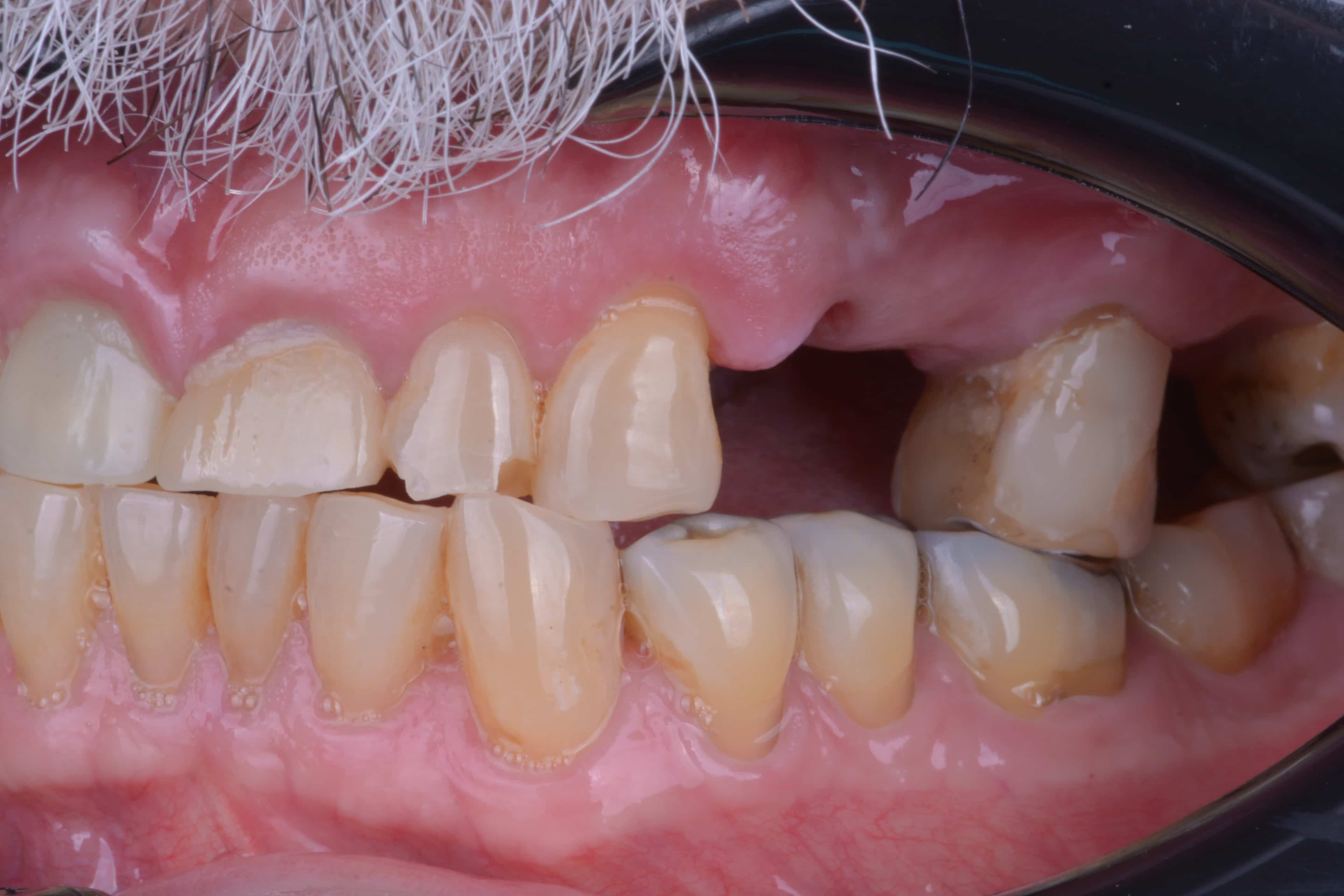 Before Puente fijo en zicornia