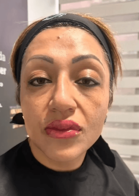 Before Armonización facial