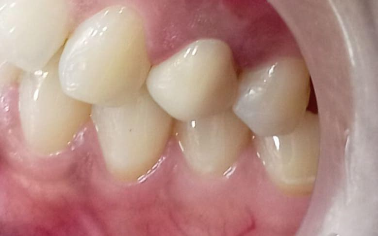 After Corona en Zirconia