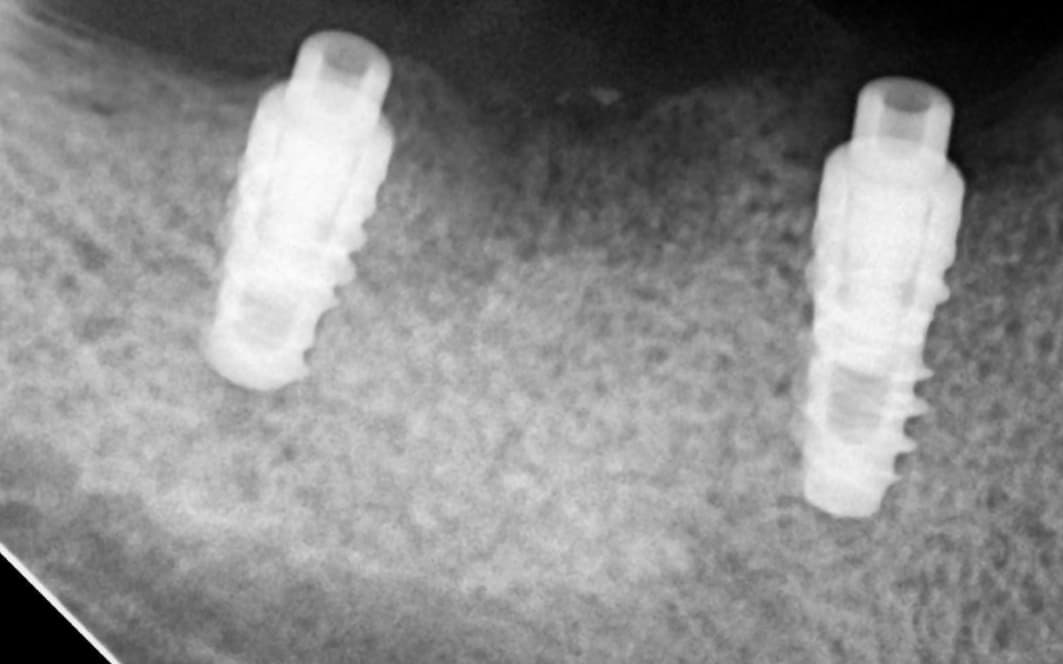 After colocación de dos implantes para reemplazar dientes perdidos y devolver comodidad y estética 