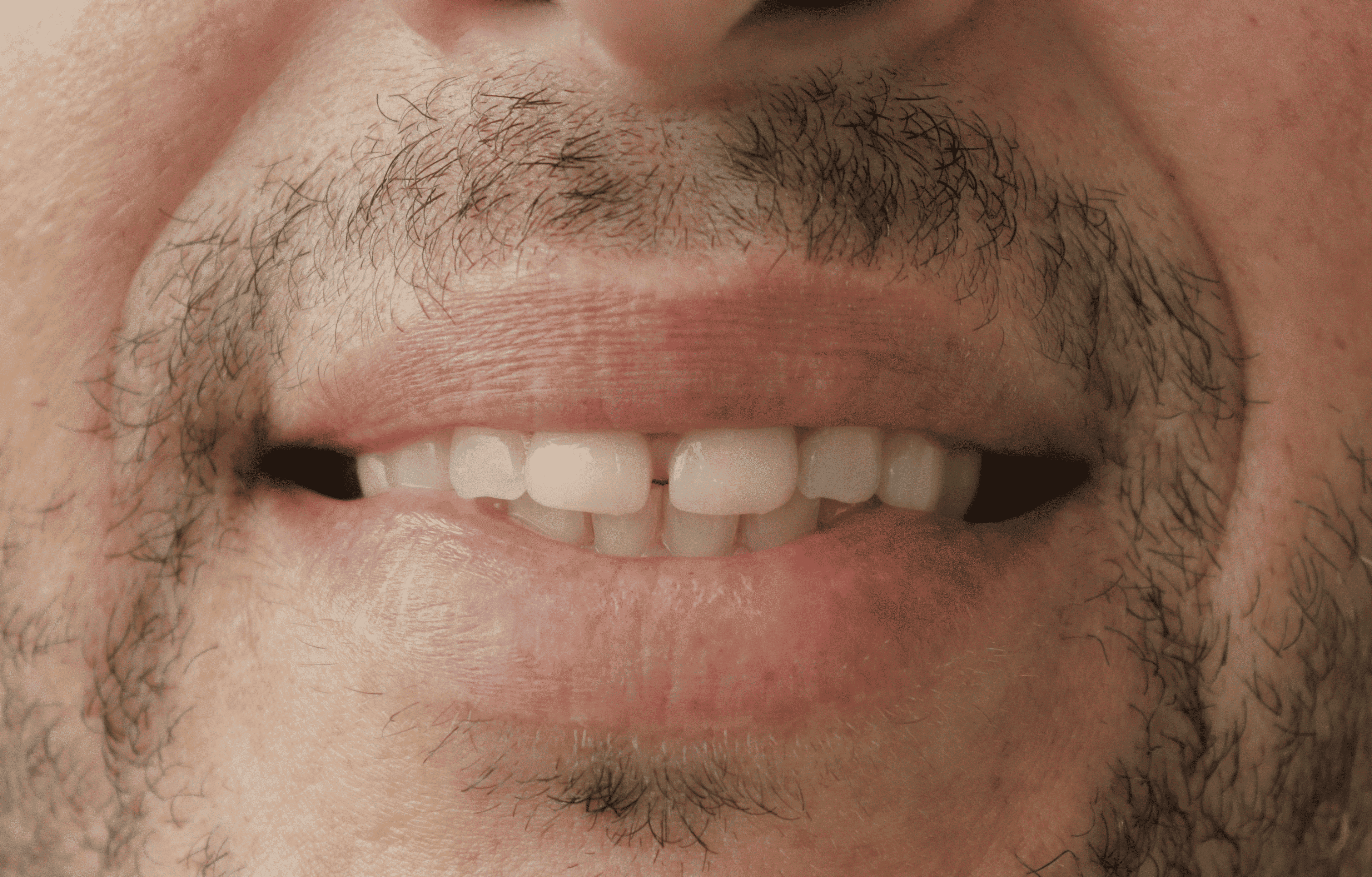 Before Lentes Cerámicos Naturales