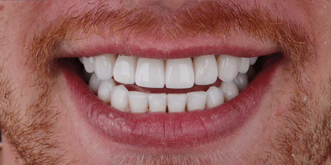 After Implantes dentales - Diseño de Sonrisa en Cerámica