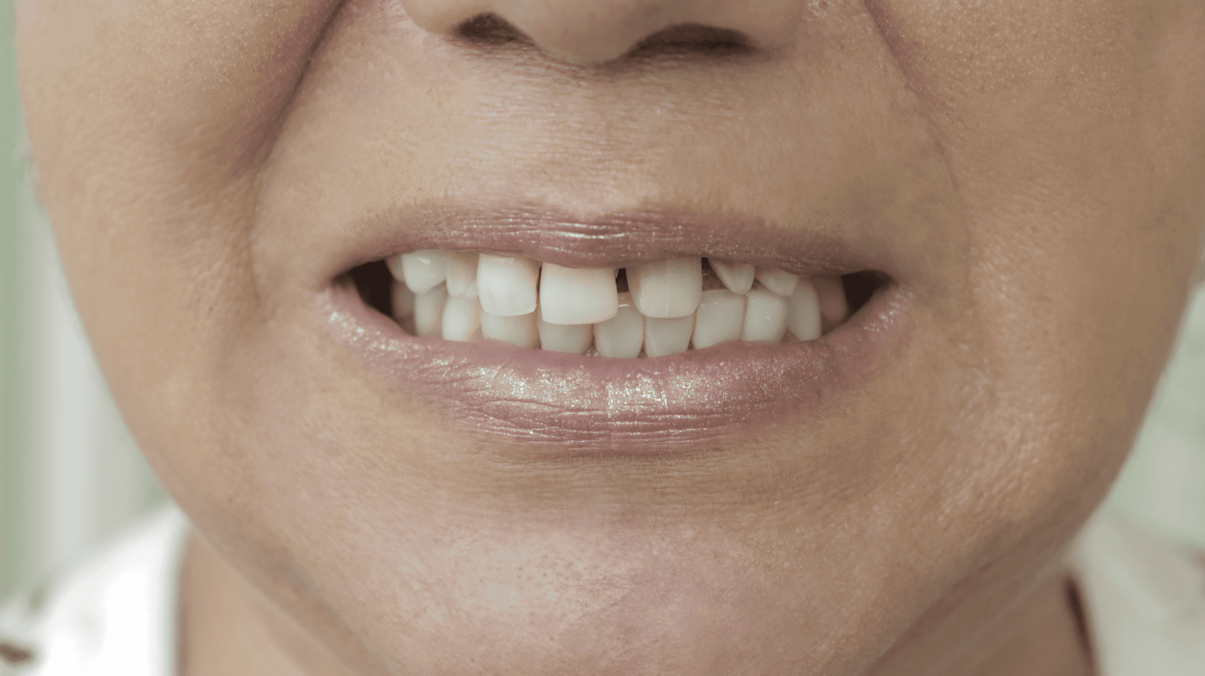 Before Lentes Cerámicos Naturales