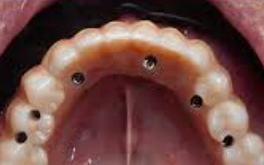 After Implants with hybrid prosthesis