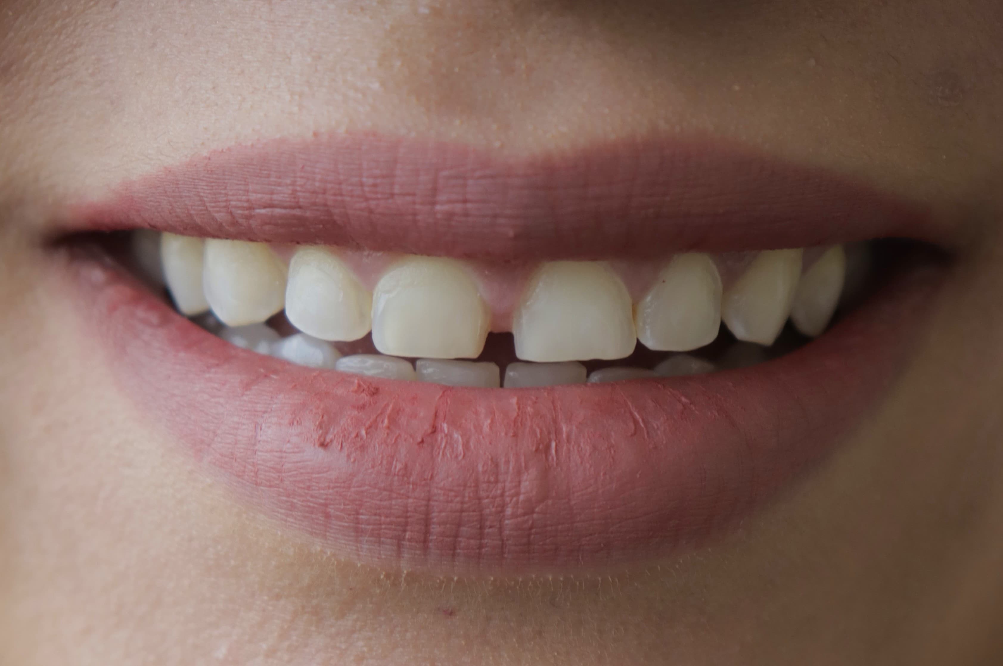 Before Lentes Cerámicos Naturales