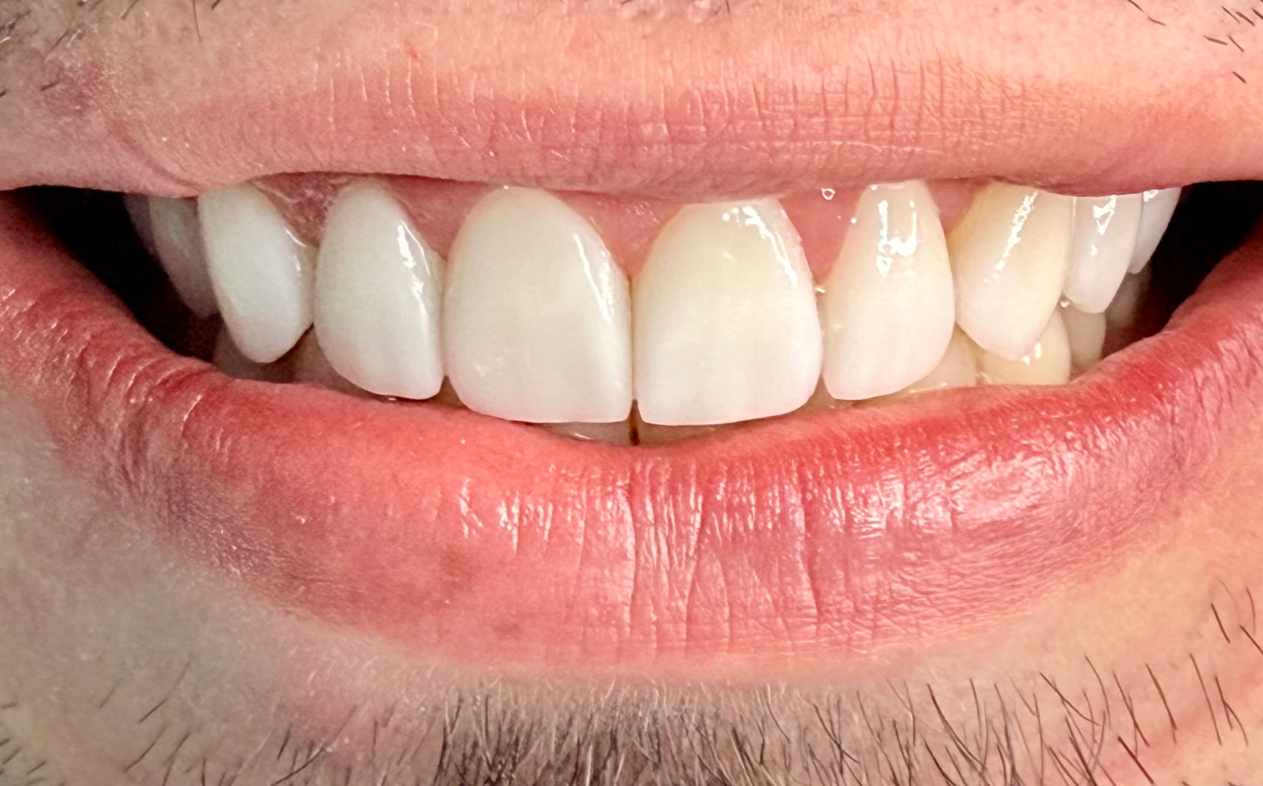 After Dental veneers