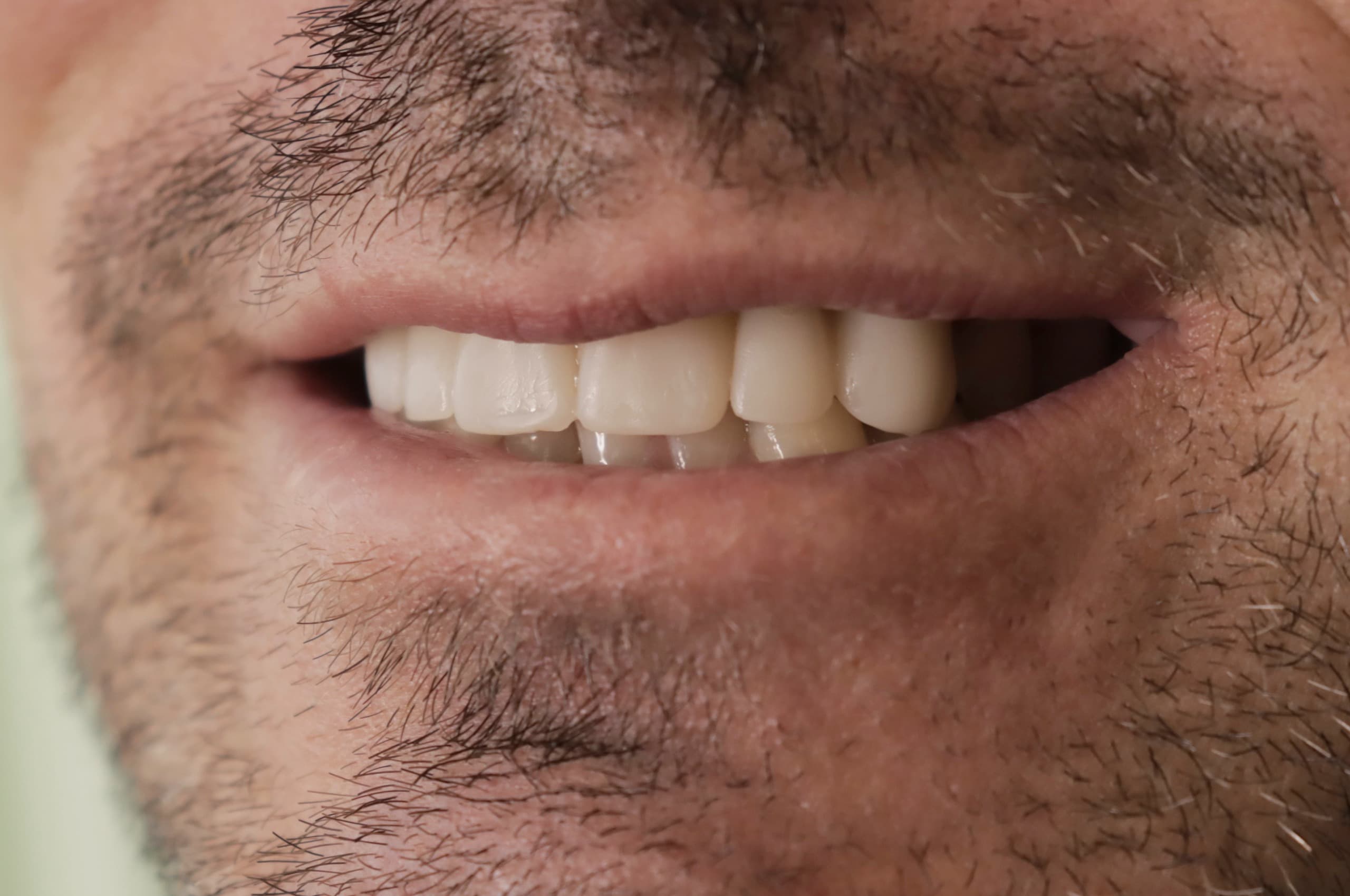 Before Lentes Cerámicos Naturales