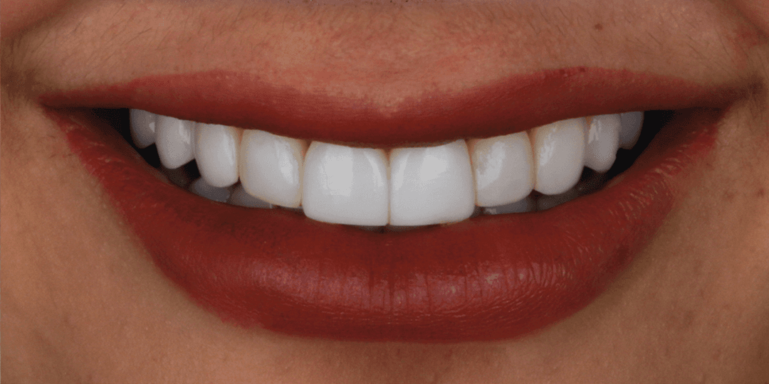 Before Diseño de sonrisa en Cerámica