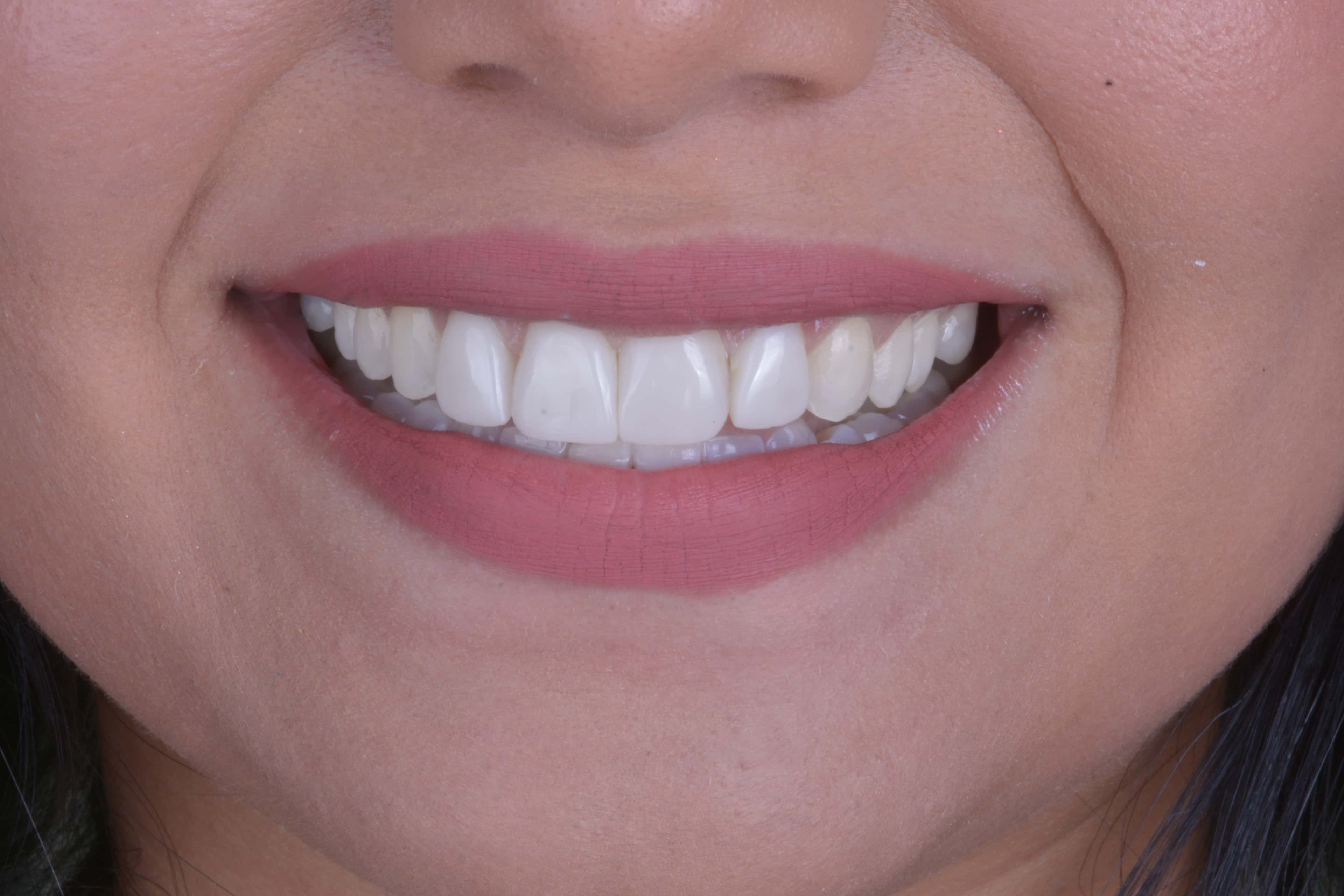 After Diseño de sonrisas