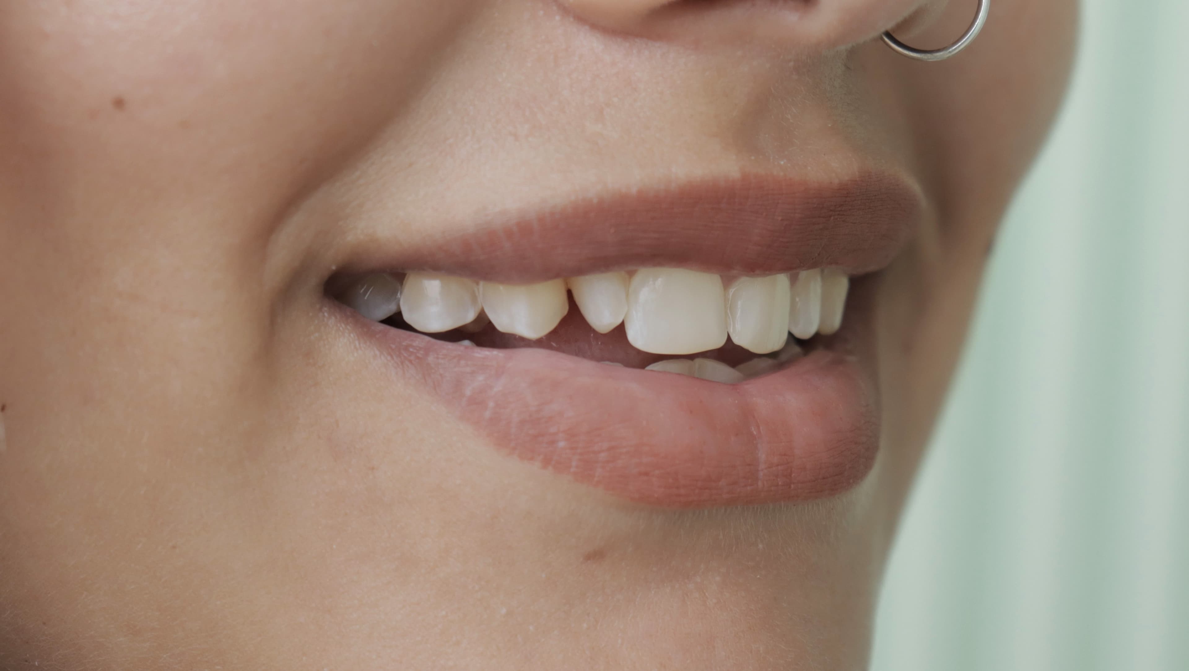 Before Lentes Cerámicos Naturales