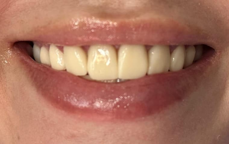 Before Porcelain veneers.