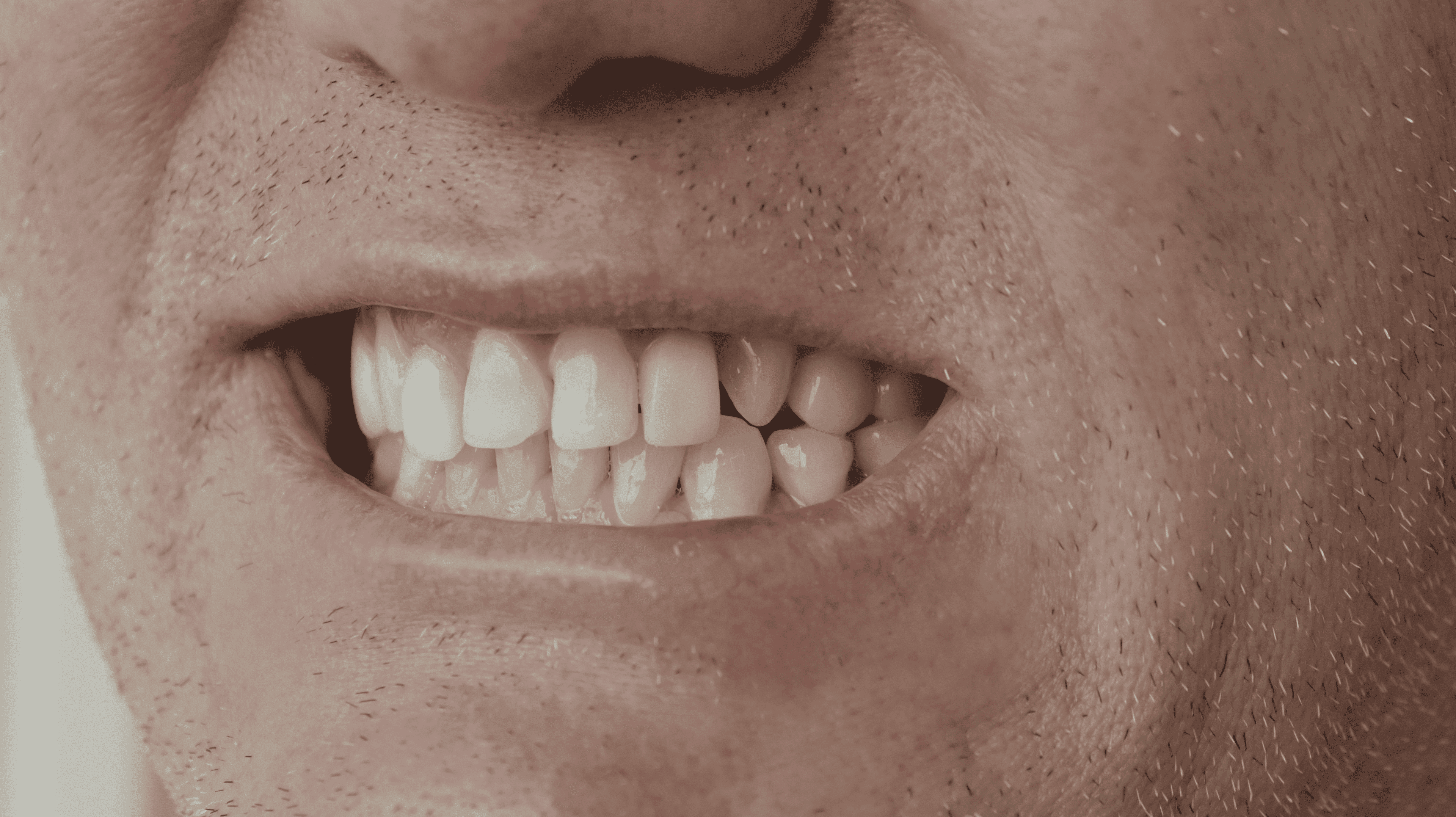 Before Lentes cerámicos naturales 